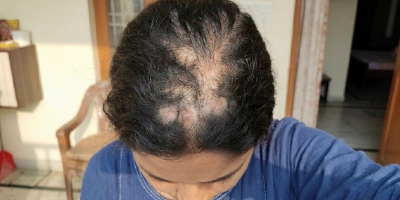 female pattern hair loss